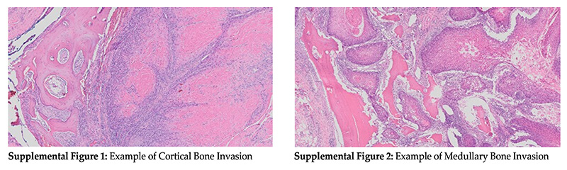 squamous cell carcinoma supplemental figure 1 2 bone invasion