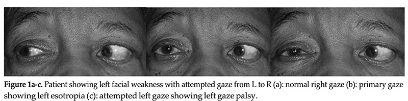 thirteen syndrome figure 1a c