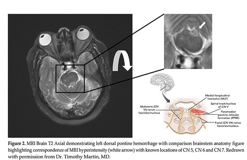 thirteen syndrome figure 2 mri brain