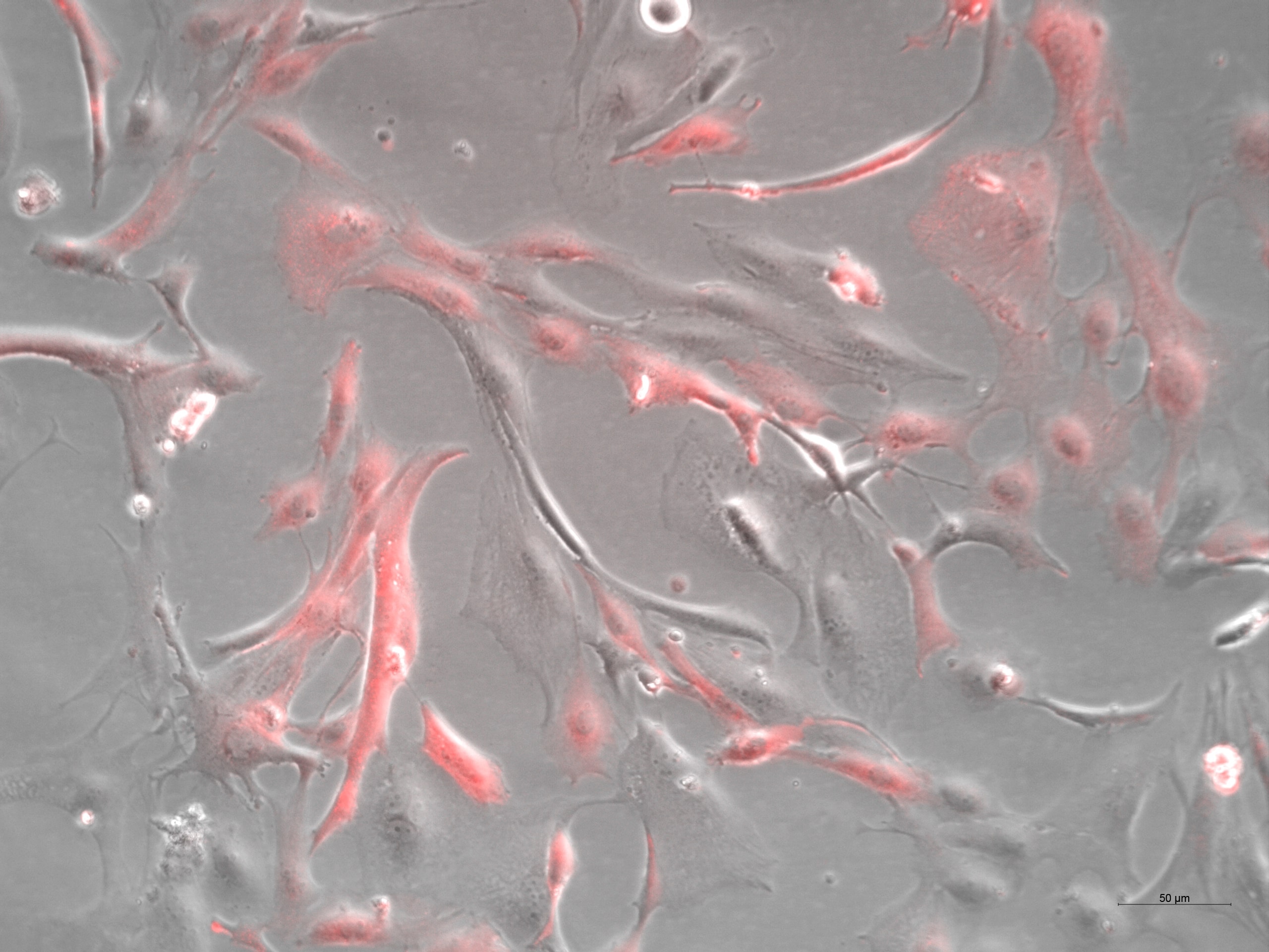 Human glioblastoma cells transfected with a lentivirus