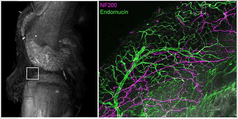 Left: x ray of knee joint; right: purple and green branchlike structures on a black background