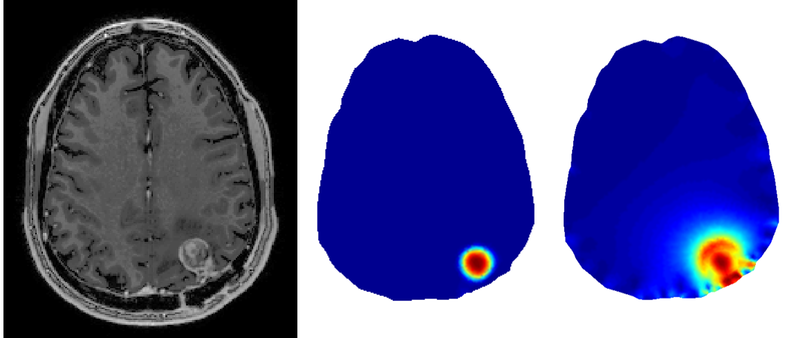 Imaging-based biophysical modeling to differentiate tumor recurrence from radiation necrosis following stereotactic radiosurgery for intracranial metastasis