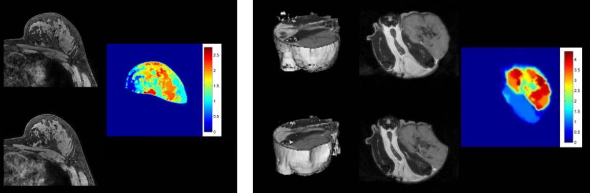 Mechanical stiffness as a biomarker to evaluate and predict breast cancer therapeutic response