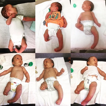 Keekly was born with a rare birth defect, and his parents were told he may never walk. With the help of an award-winning orthopedic surgery program, he’s not just walking into preschool – he’s running.