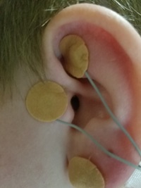 A tiny device that fits behind the ear offers big pain relief to kids and teenagers with IBS.