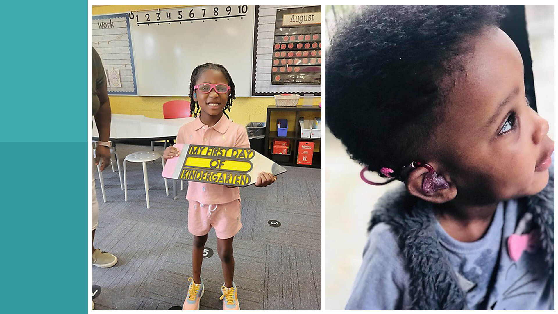 A collage of a small child with her head turned to the right wearing a hearing assistance device in her ear on the right and the same child at her first day of kindergarten on the left.