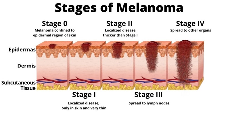 Graphic explaining the different stages of melanoma