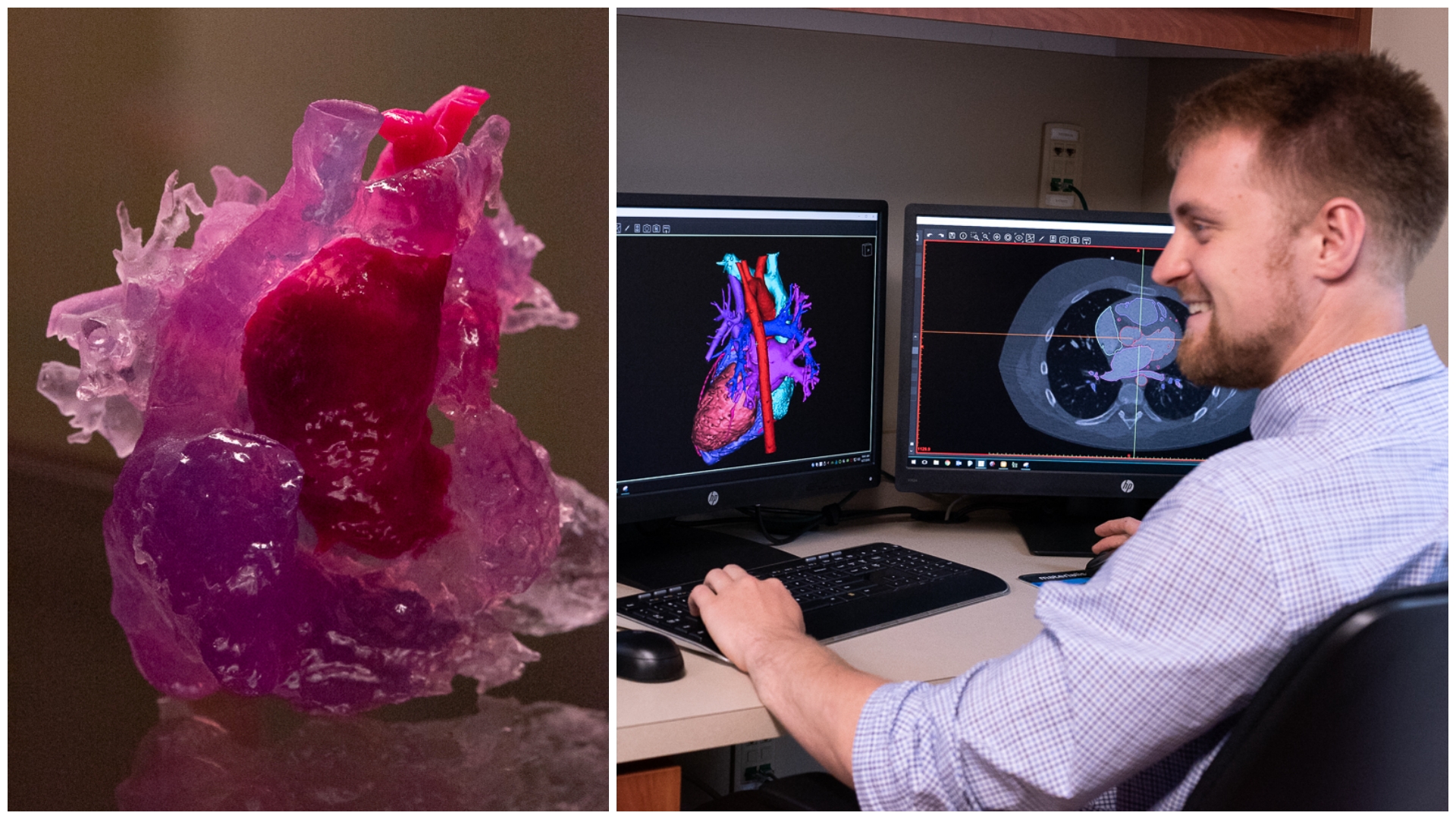 Thanks to a new state-of-the-art 3D printer, families of children with serious heart defects can now hold a model of their child’s heart in their hands. See how doctors at Atrium Health’s Levine Children’s Hospital are creating three-dimensional replicas of kids’ hearts to help improve procedures and patient education. 