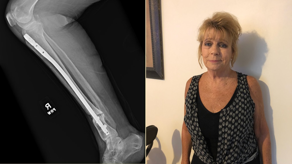 After a stress fracture in 2017, Cathy Hixson started on a long, frustrating orthopaedic journey. 