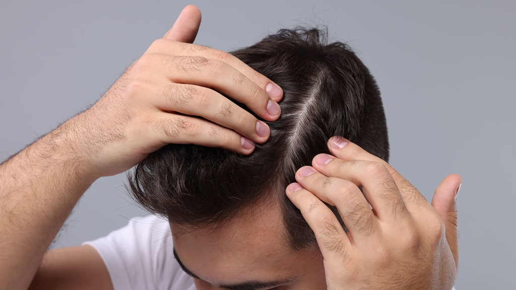 Why You Might Be Losing More Hair Than Usual
