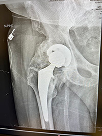 An X-ray of a hip.