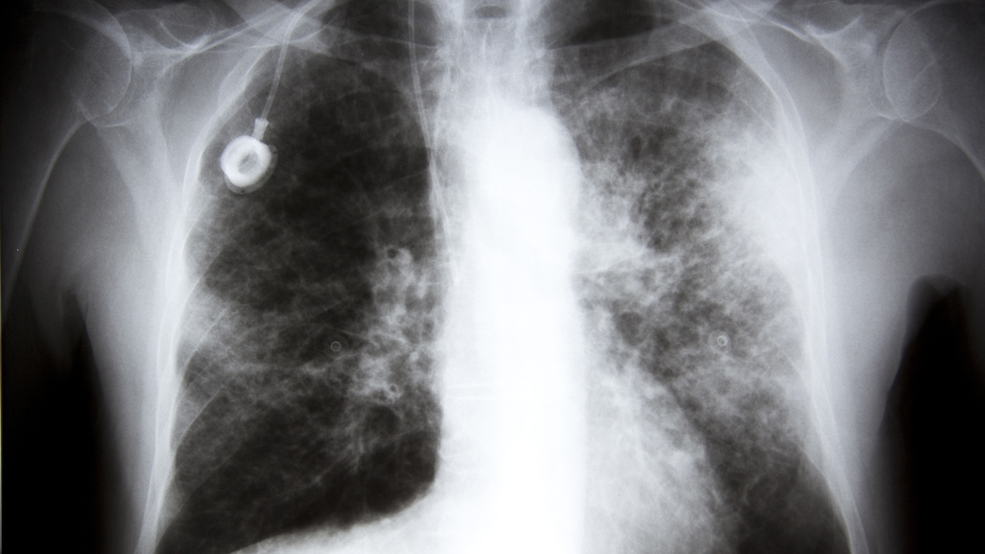 Treating Stage IV Lung Cancer With a Pill 
