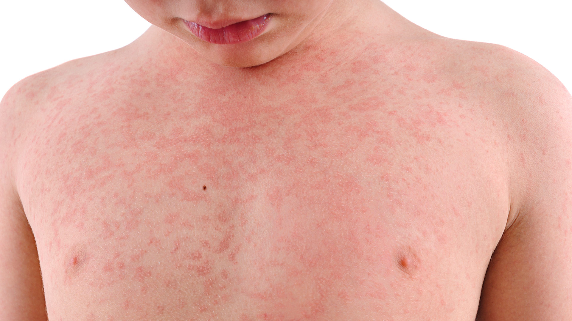 With more cases being reported regularly, we’re in the midst of the worst measles outbreak since 1994. We spoke to two Atrium Health pediatricians about the precautions parents should take.