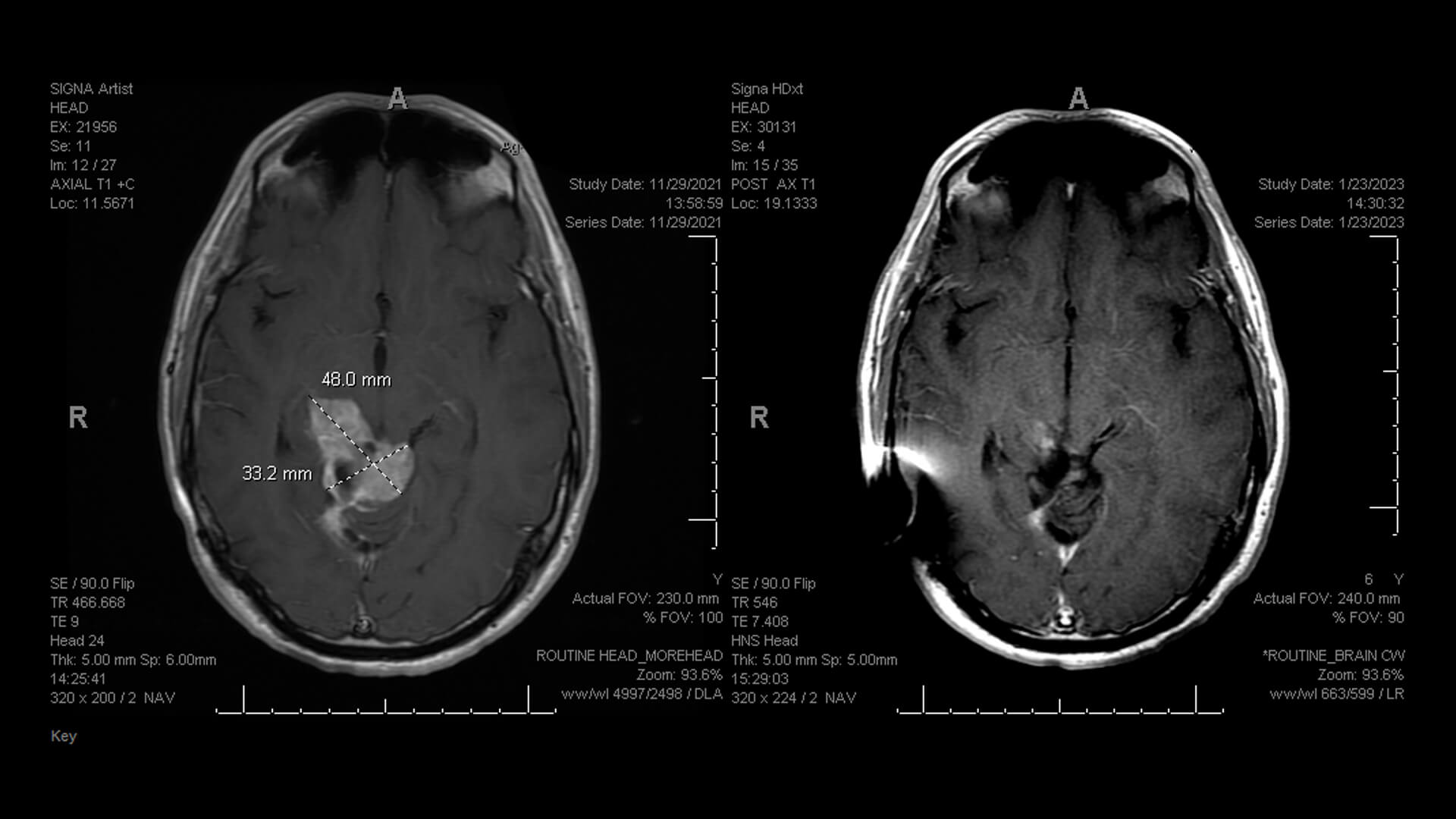 Ethan Davis Brain Tumor